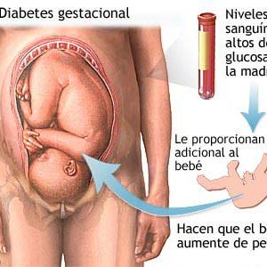  High Blood Pressure And Its Relation To Diabetes, Obesity &Amp;Amp; Exercise